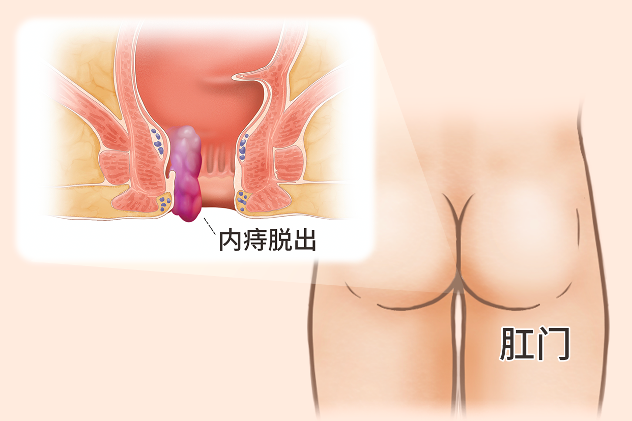 内痔痔核脱出的照片（内痔痔核脱落图片）