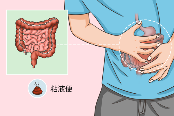 溃疡性结肠炎粘液便图片 溃疡性结肠炎大便粘液照片