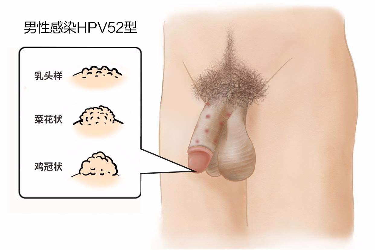 hpv52疣体长什么样