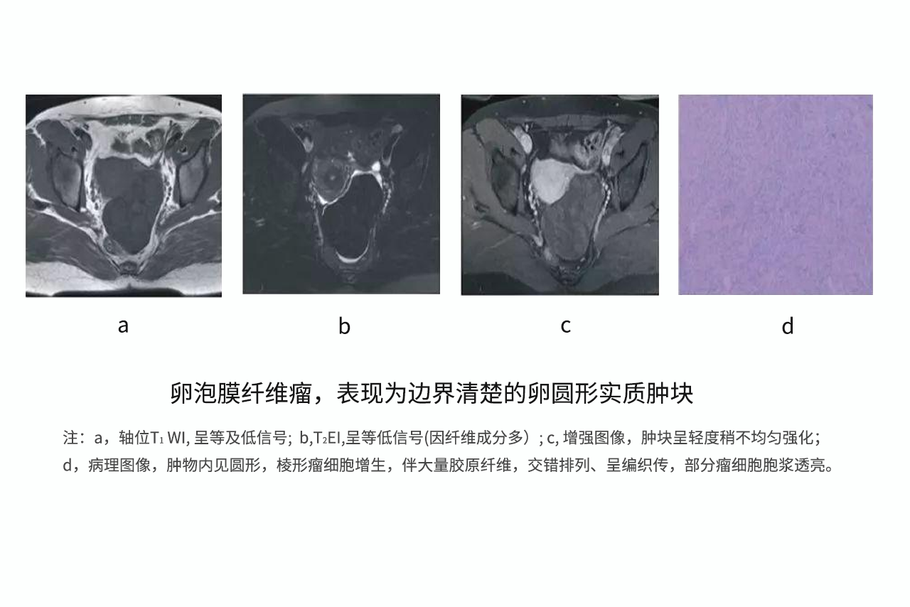 纤维卵泡膜细胞瘤图片