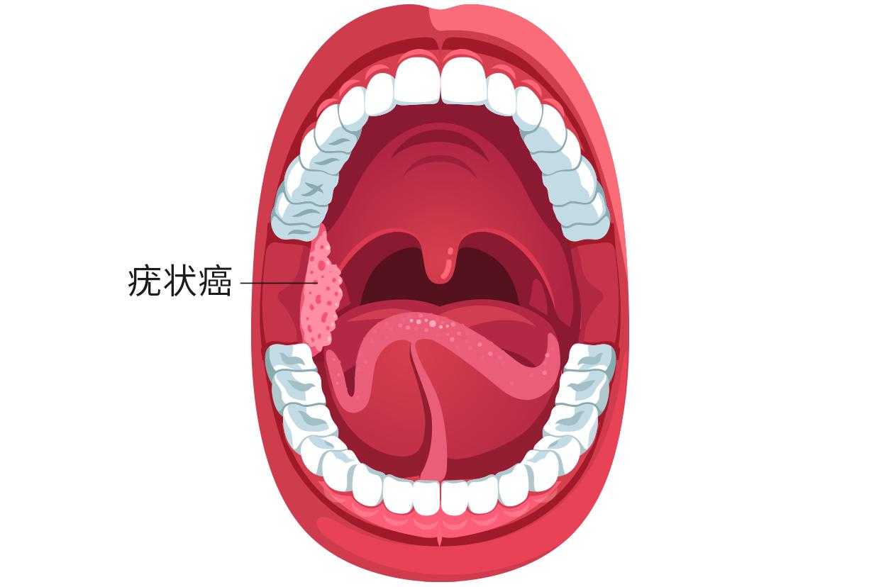 疣状癌图片