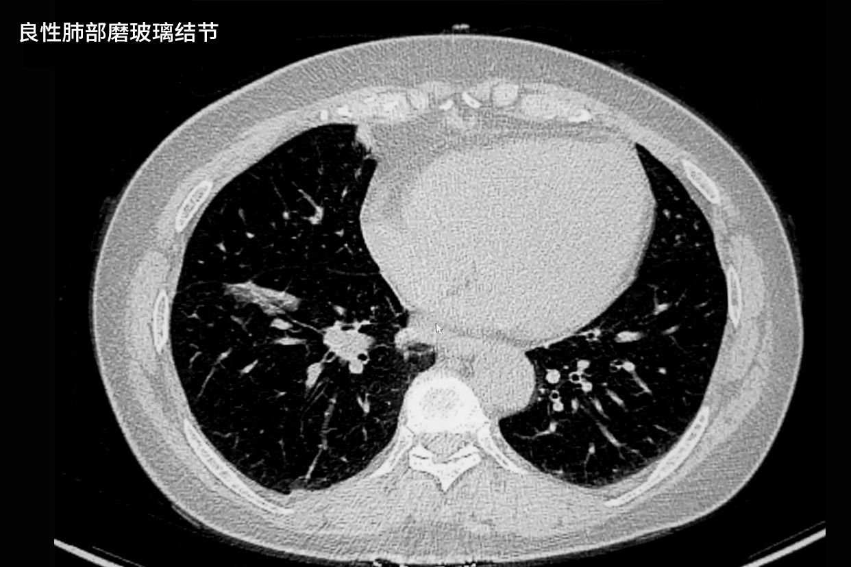 良性肺部磨玻璃结节影像图