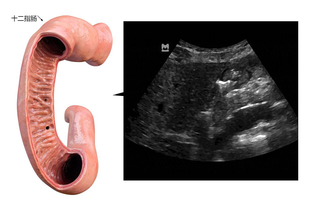 十二指肠超声图像