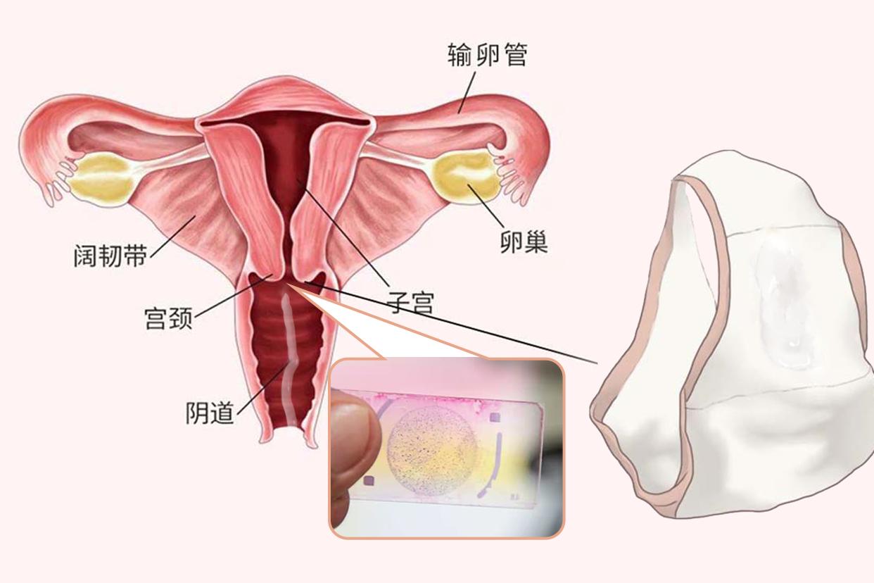 做完宫颈活检一周流水样液体正常吗图片