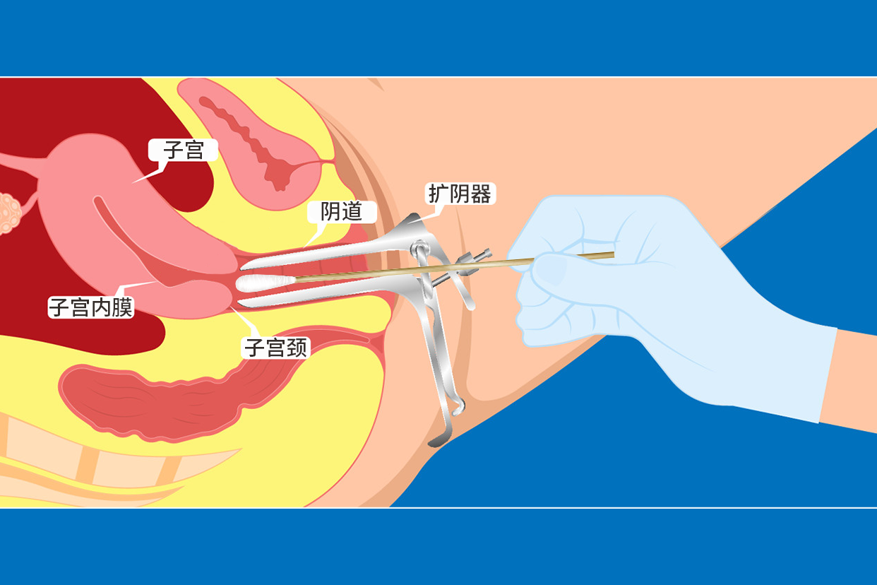 扩阴器阴道上药图片