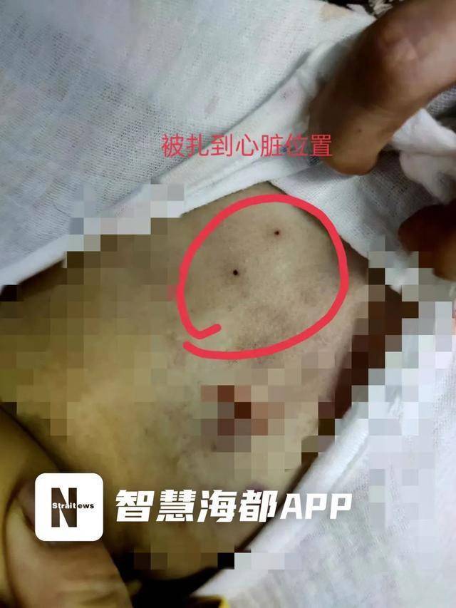 事发厦门一医院！穿刺操作失误，4岁女童命丧手术台