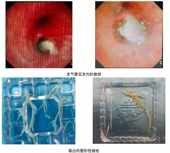 7岁男童肺部实变！有医院一天最高峰67例“洗肺”……