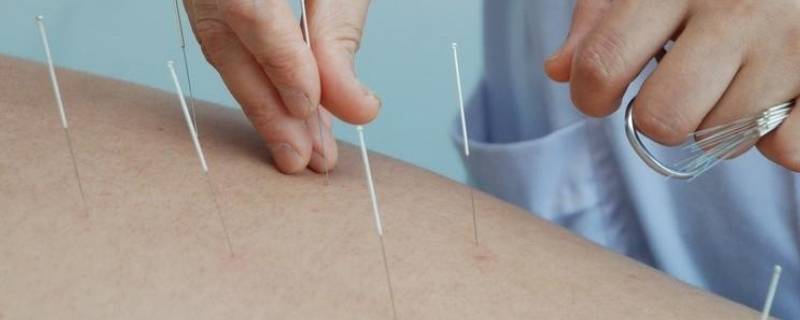 针灸的发源地 针灸发源地讲解